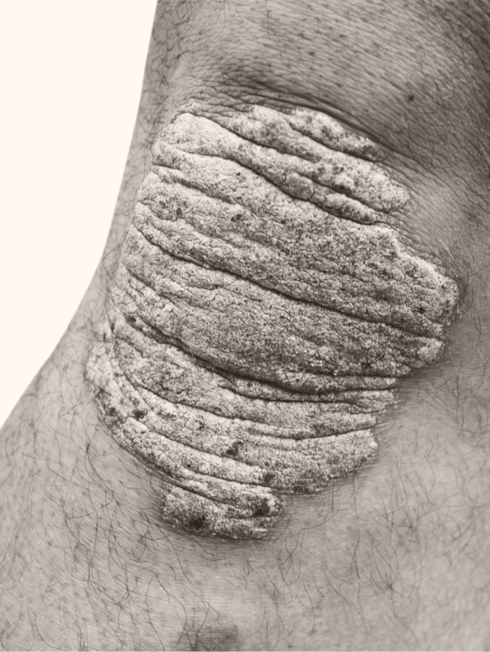 Un genou avec une large plaque de psoriasis