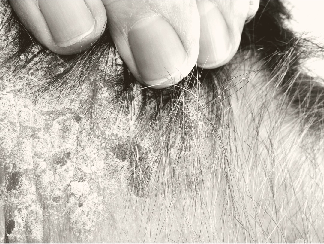 Patient qui tire ses cheveux vers l’arrière pour montrer le psoriasis sur son crâne.