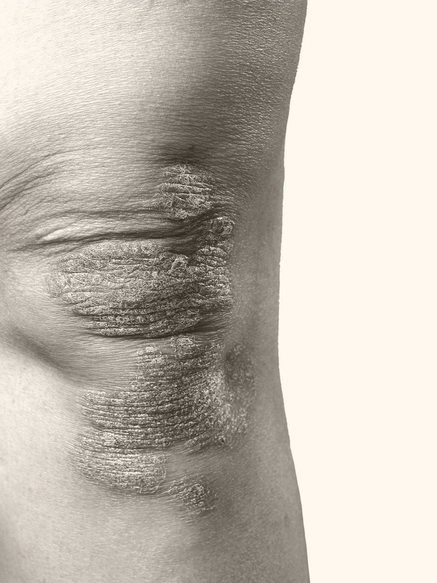 Knee of a patient with plaque psoriasis. Knee partially covered by scaly plaques.