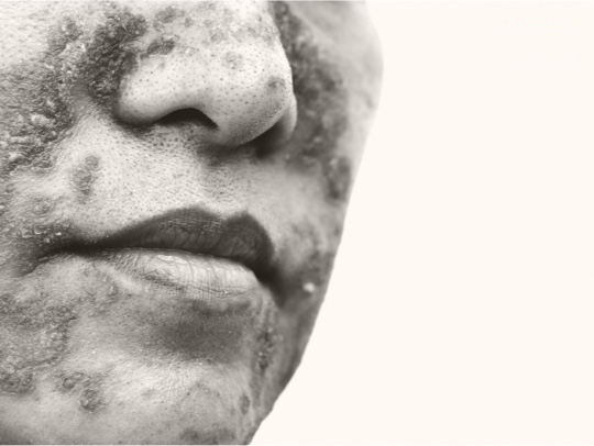 Le nez, la bouche et menton d’une patiente avec une maladie de peau.