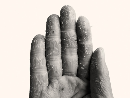 Hand of a patient with skin disease. Fingers covered with dry, peeling skin