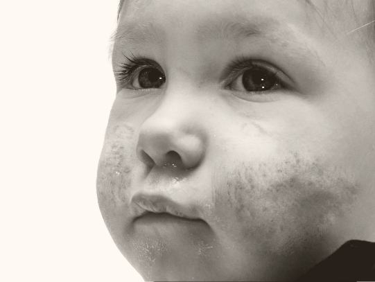 Face of an infant with skin disease. Infant has redness on cheeks.