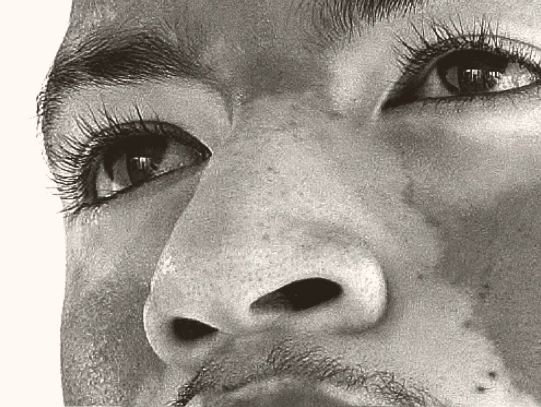 Face of a person of colour with skin disease. Skin condition covers upper portion of face.