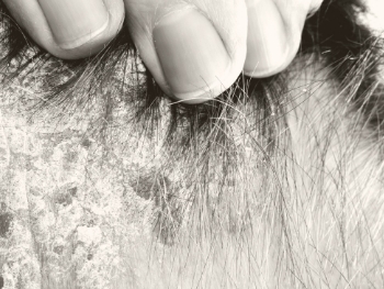 Scalp of a plaque psoriasis patient with dryness and scaling.