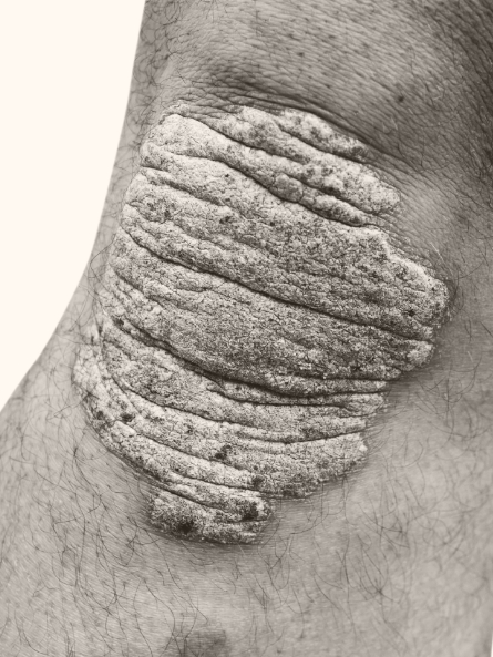 Knee of a person of colour with a large plaque. Plaque appears raised and thick.