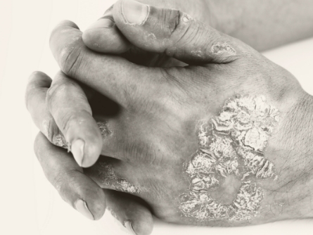 Hands of a patient with plaque psoriasis with fingers interlaced.
