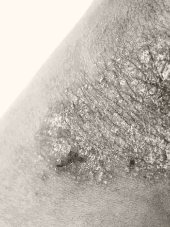 Skin of a ptient with plaque psoriasis. The skin looks dry and red.