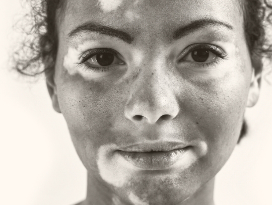 Face of a woman of colour with skin disease.